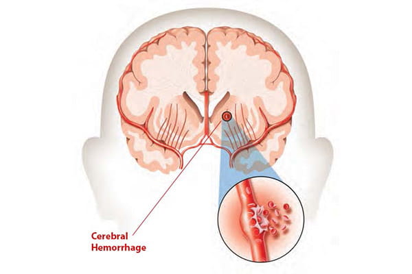 medical illustration of a cerebral hemorrhage