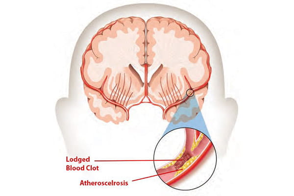 medical illustration of an ischemic stroke condition in the brain